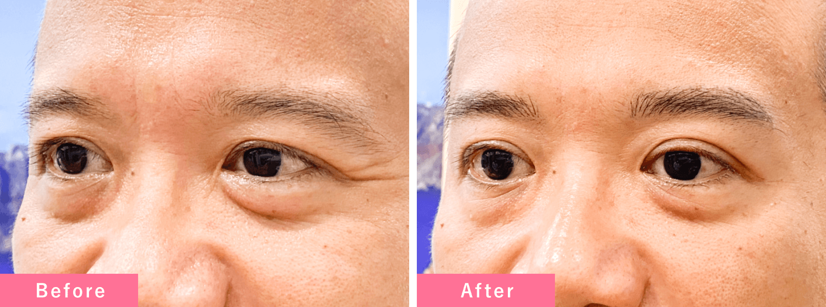 アートメイク症例写真