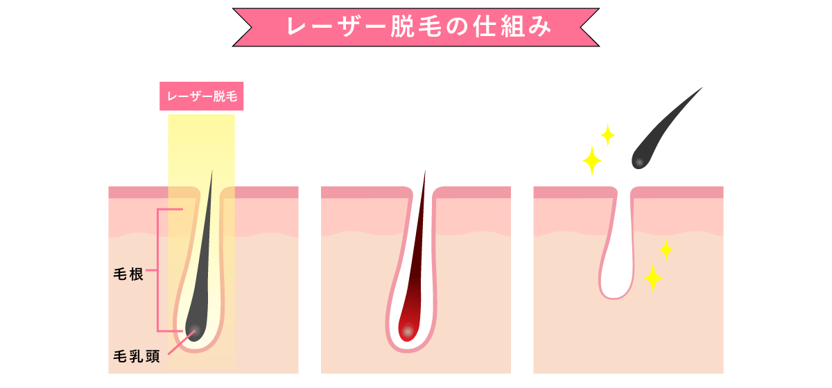 医療レーザー脱毛の仕組み